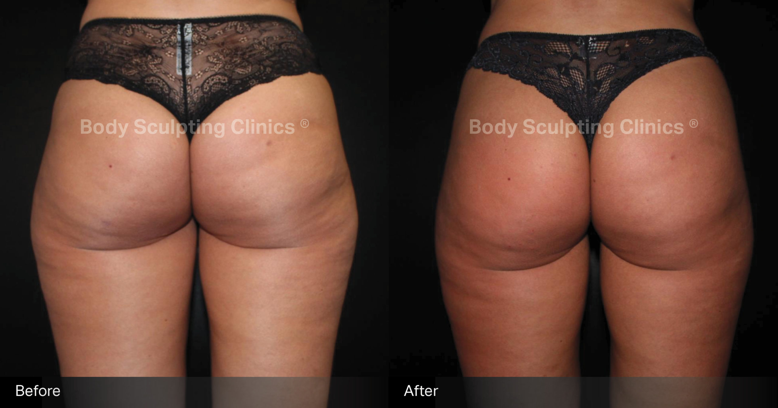 sculptra-bbl-Female-1