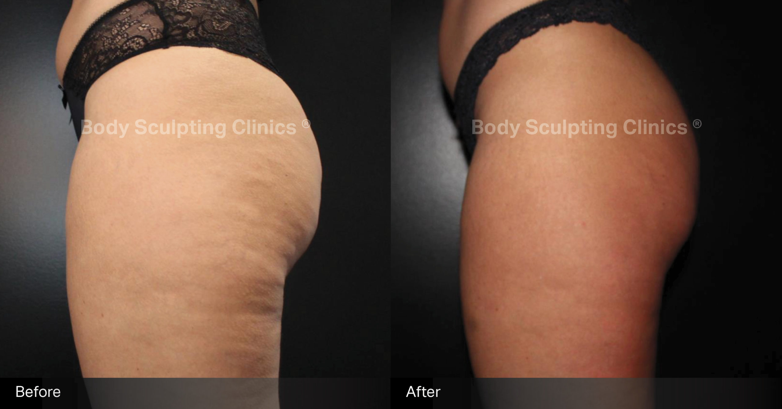 sculptra-cellulite-Female-1