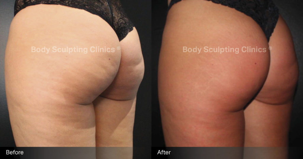 sculptra-cellulite-treatment-before-after-4