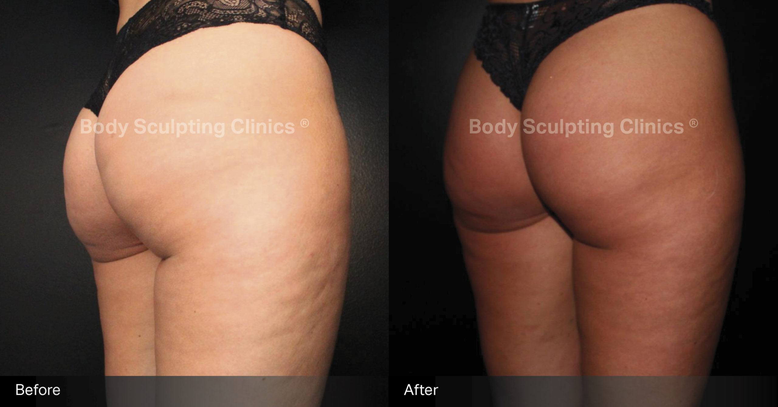 sculptra-cellulite-Female-3
