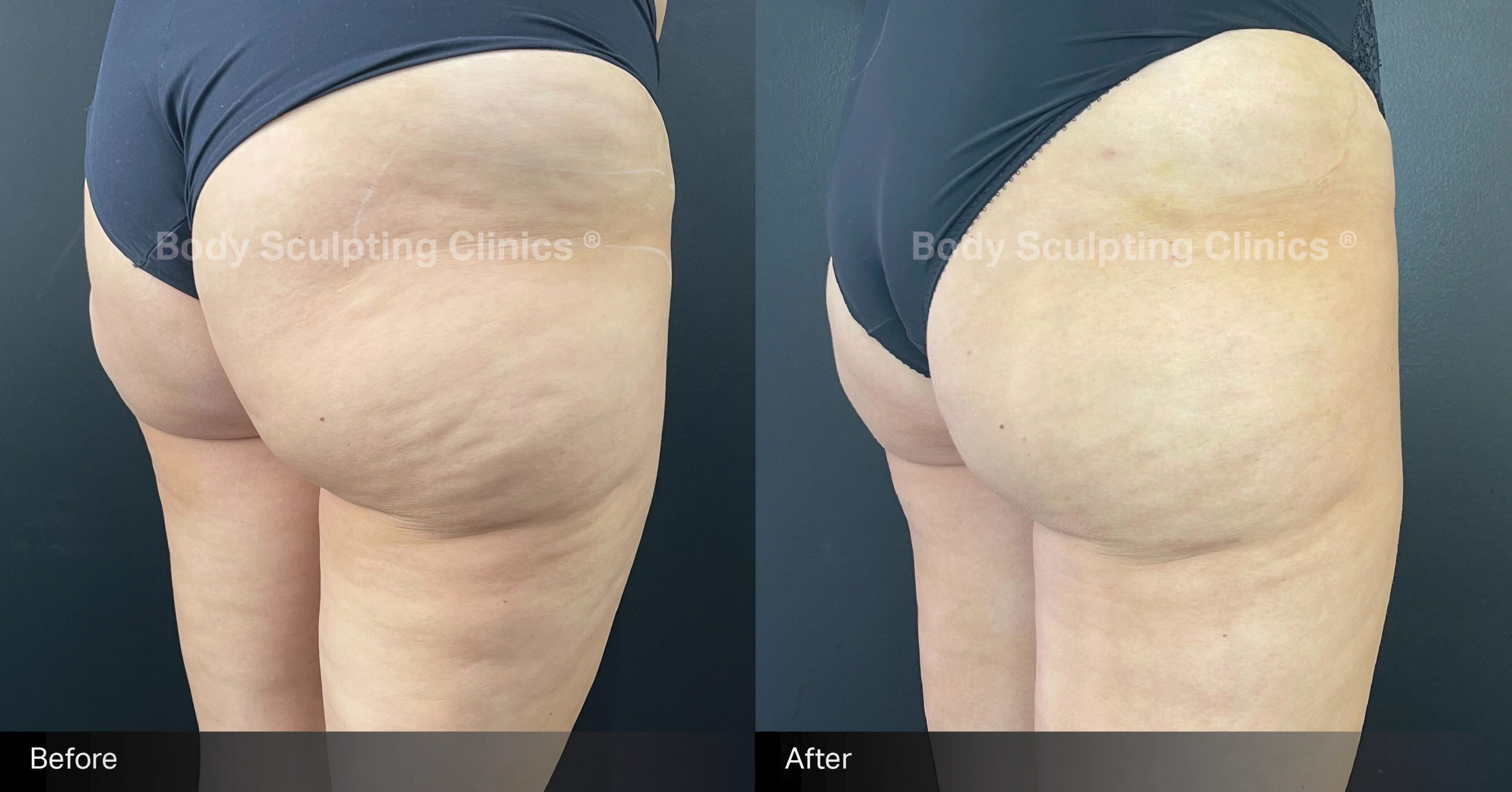 sculptra-cellulite-treatment-before-after-3