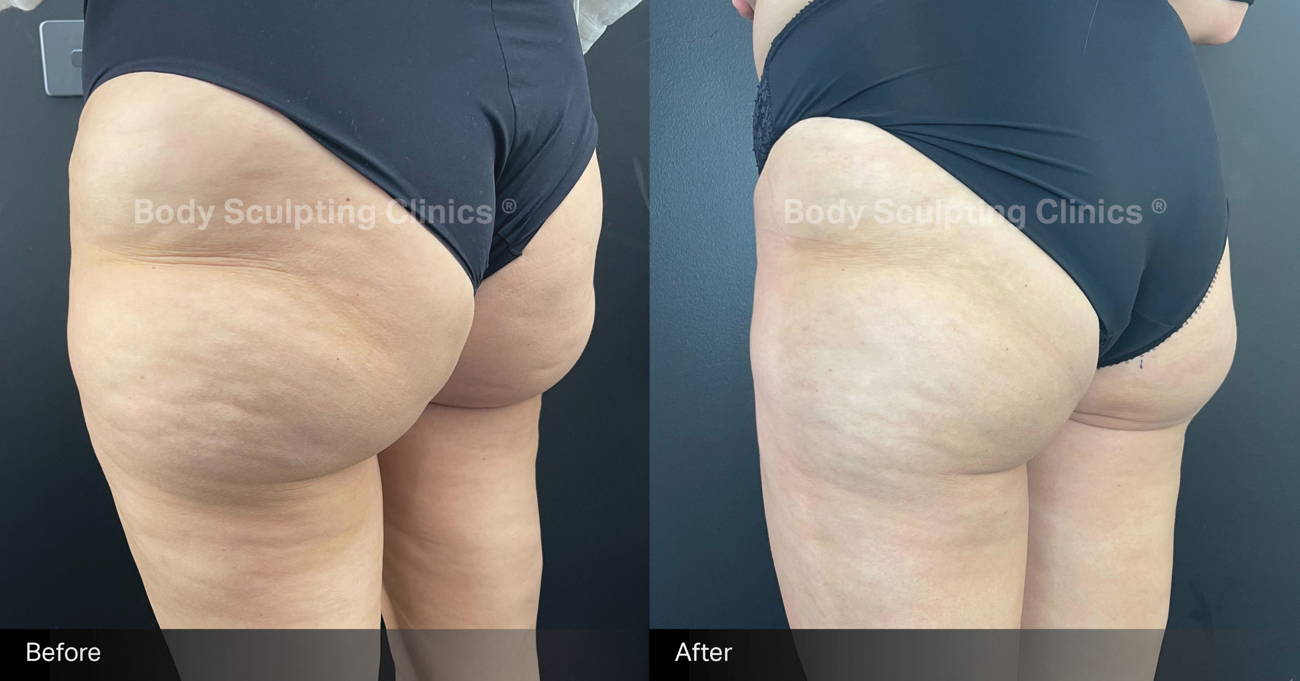 sculptra-cellulite-treatment-before-after-1