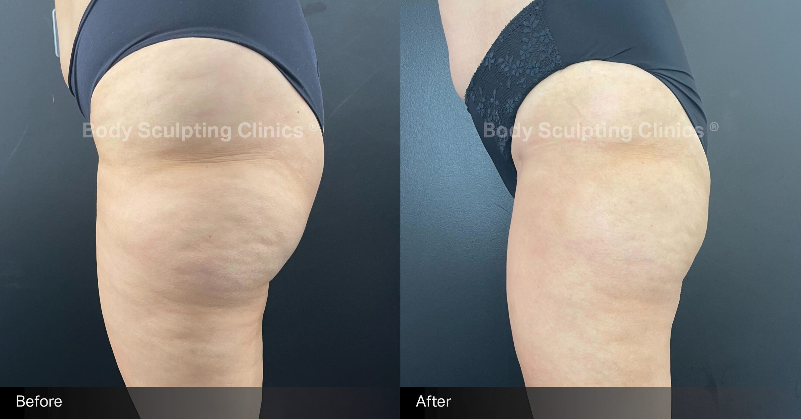 sculptra-cellulite-treatment-before-after