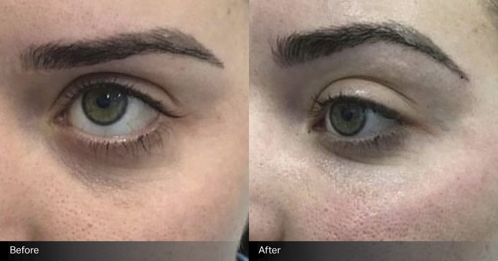 body-sculpting-clinics-sydney-under-eye-filler-before-after-003