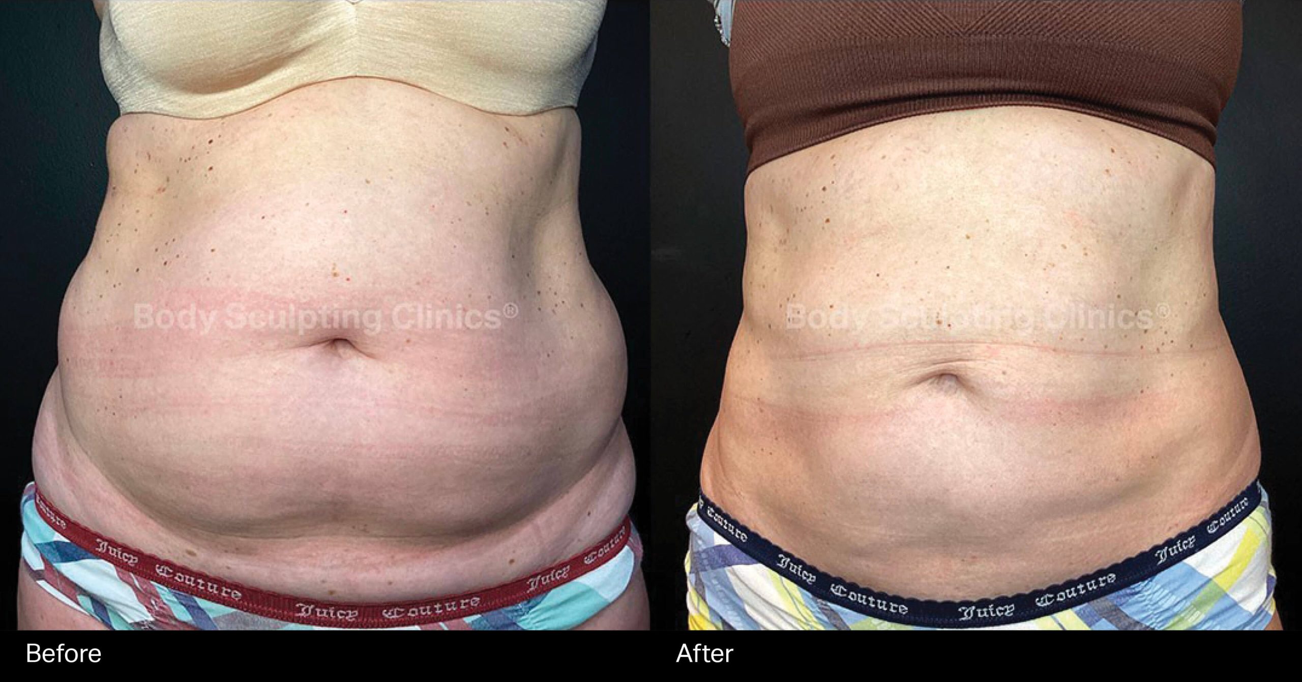 Transform your abdomen with Body Sculpting Clinics Sydney’s TGA registered fat freezing treatment. Non-surgical, precise, and effective body contouring for a beautifully sculpted silhouette.