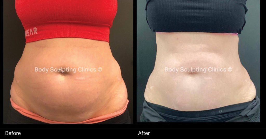 Transform your abdomen with Body Sculpting Clinics Sydney’s TGA registered fat freezing treatment. Non-surgical, precise, and effective body contouring for a beautifully sculpted silhouette.