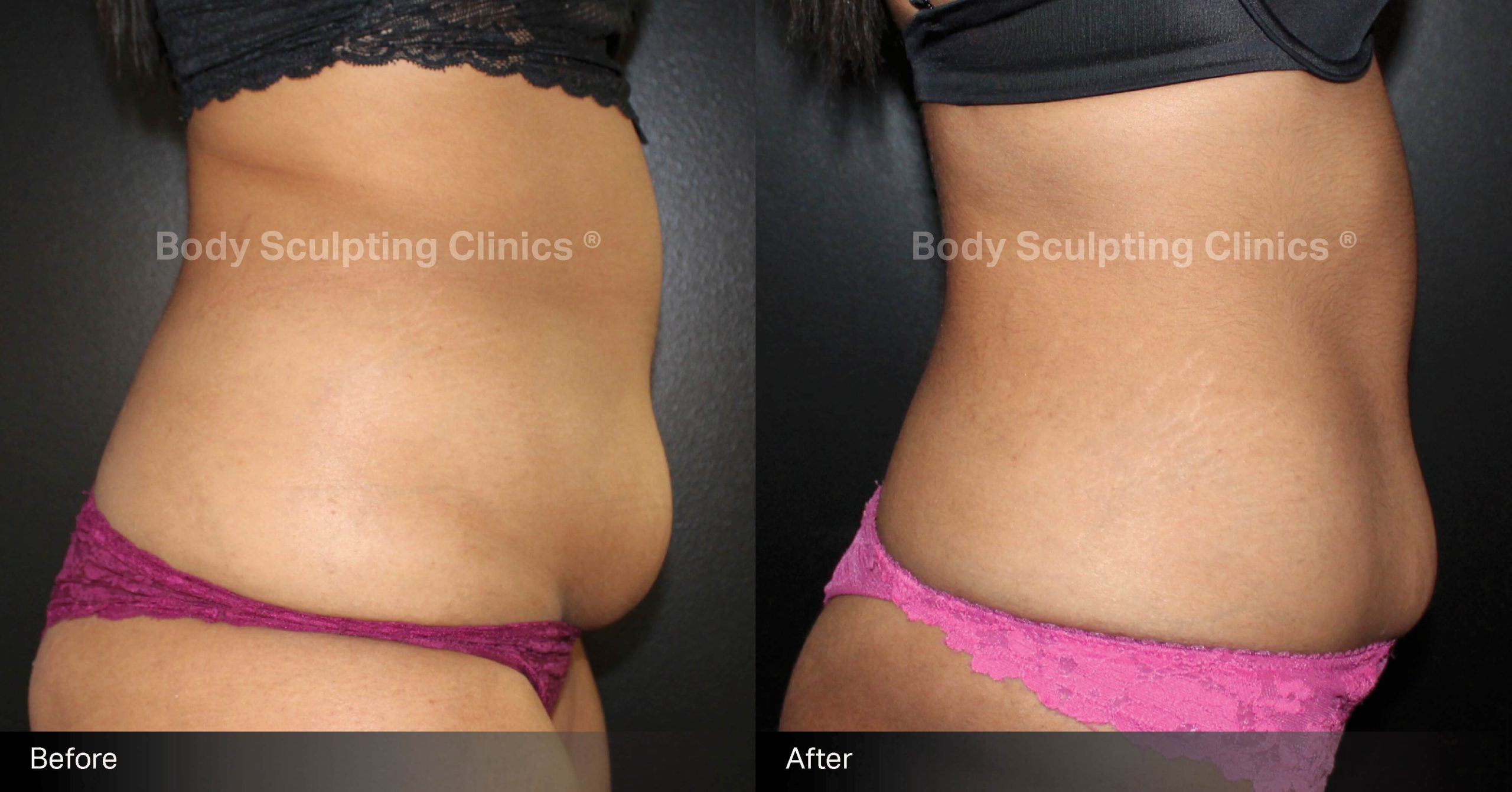Transform your abdomen with Body Sculpting Clinics Sydney’s TGA registered fat freezing treatment. Non-surgical, precise, and effective body contouring for a beautifully sculpted silhouette.