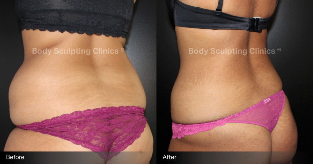 Transform your abdomen with Body Sculpting Clinics Sydney’s TGA registered fat freezing treatment. Non-surgical, precise, and effective body contouring for a beautifully sculpted silhouette.