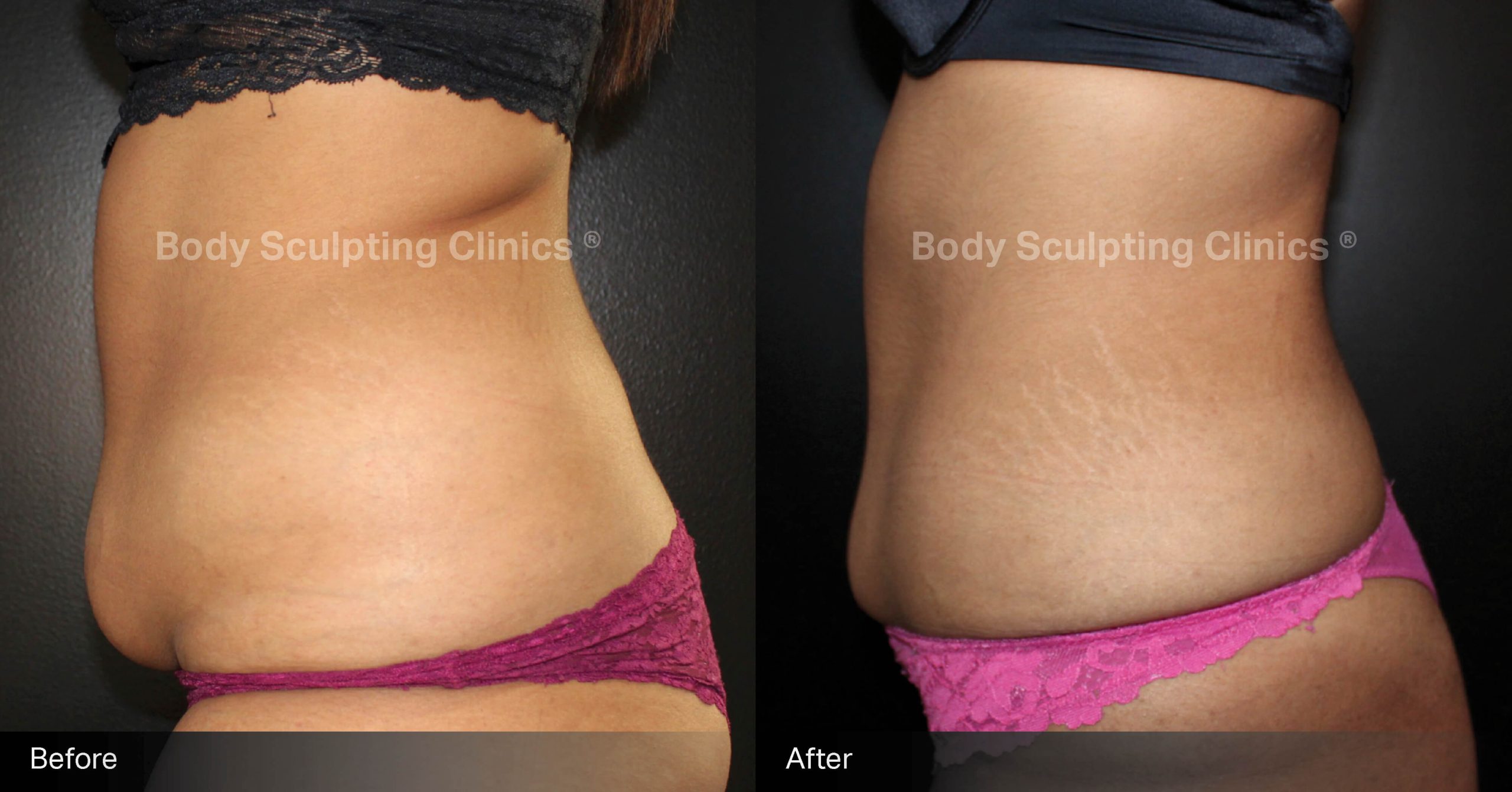 Transform your abdomen with Body Sculpting Clinics Sydney’s TGA registered fat freezing treatment. Non-surgical, precise, and effective body contouring for a beautifully sculpted silhouette.