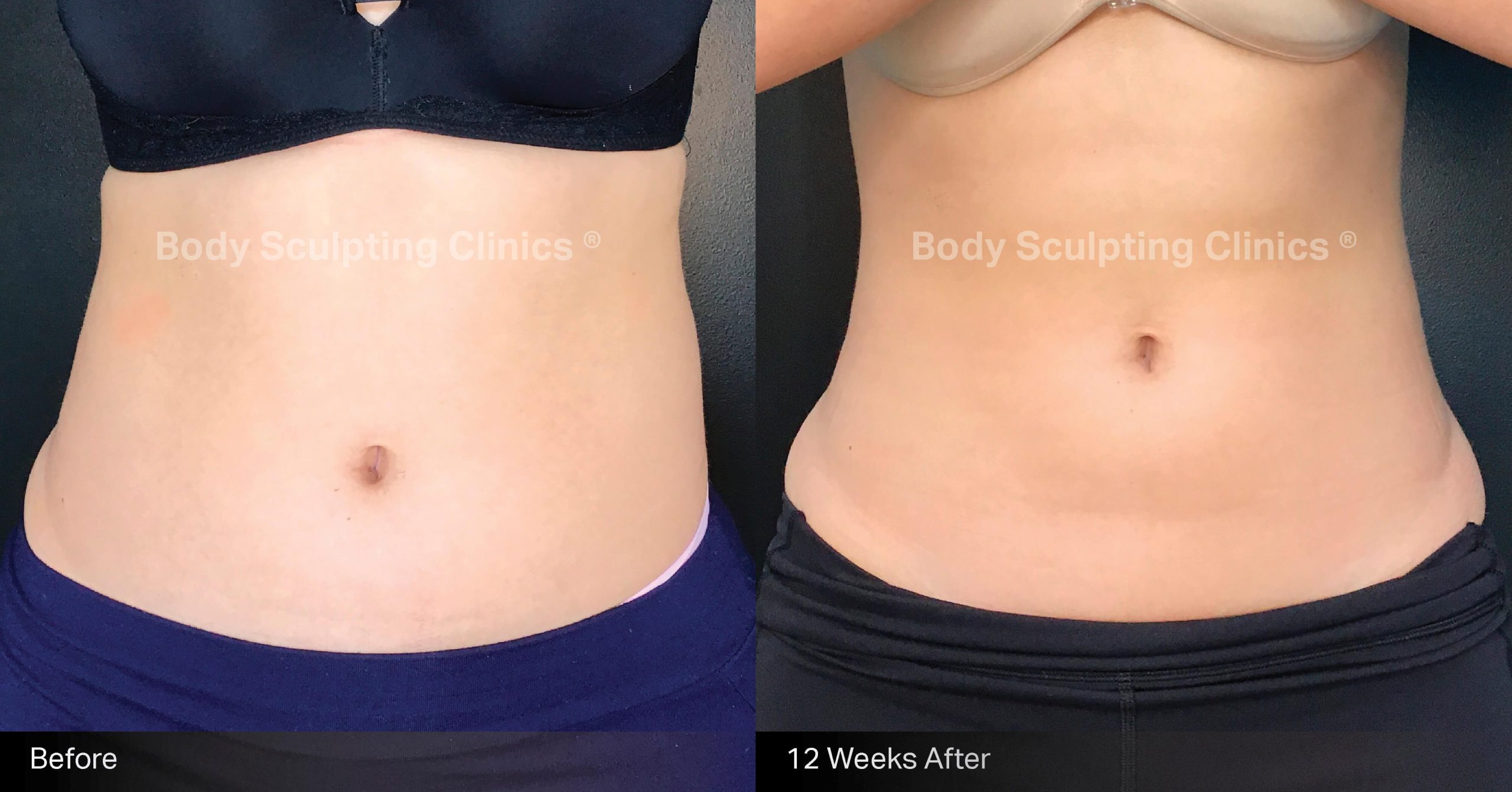 Transform your abdomen with Body Sculpting Clinics Sydney’s TGA registered fat freezing treatment. Non-surgical, precise, and effective body contouring for a beautifully sculpted silhouette.