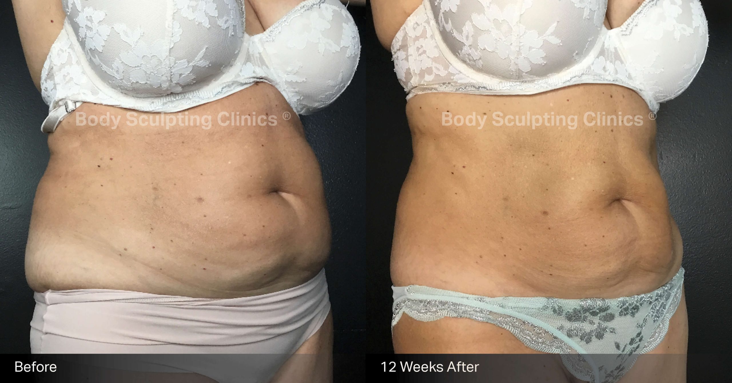 fat-freezing-before-after-body-sculpting-clinics-sydney-abdomen-00006