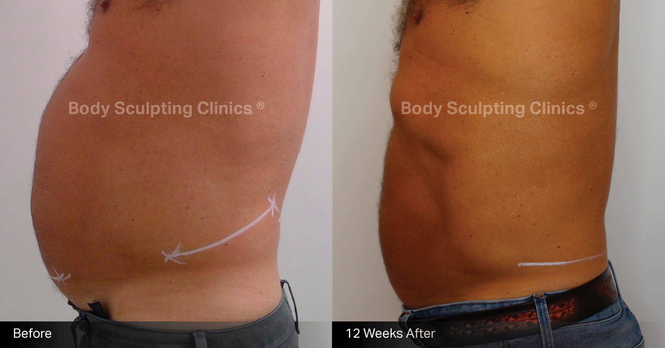 Before and after fat freezing treatment on the abdomen at Body Sculpting Clinics Sydney — TGA-approved, non-invasive fat reduction with visible body contouring results.