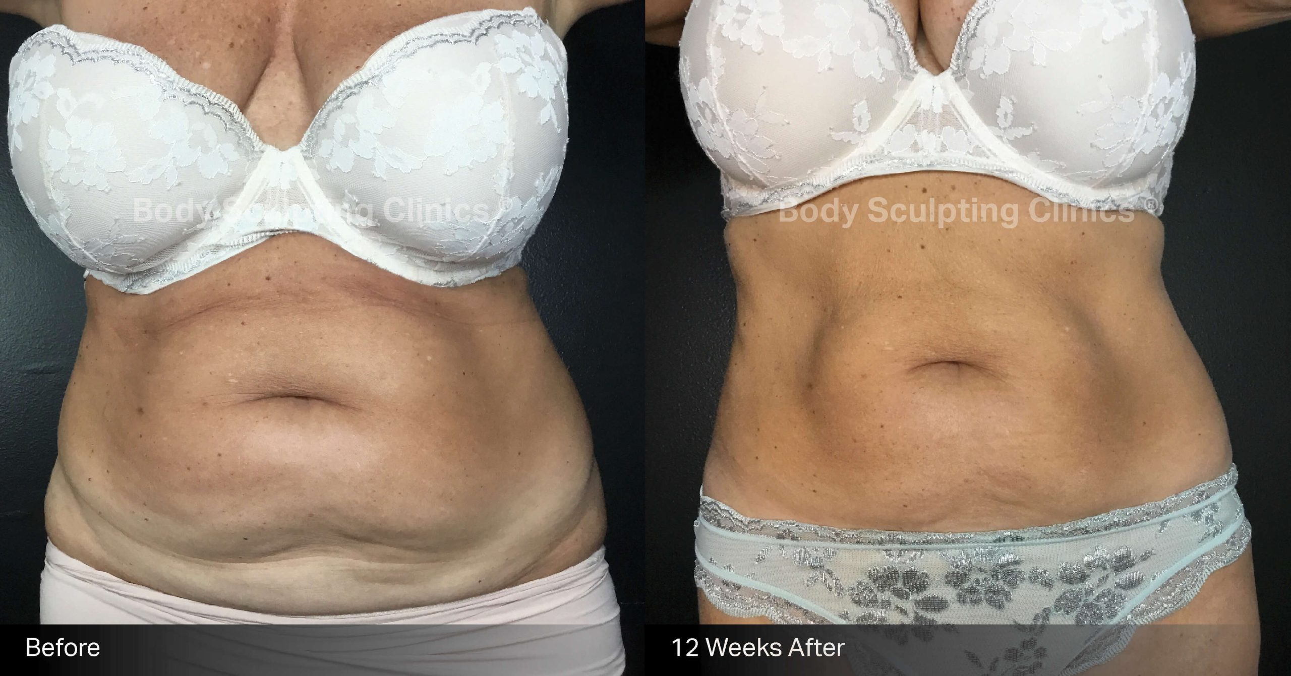 Before and after fat freezing treatment on female abdomen at Body Sculpting Clinics Sydney — TGA-approved, non-invasive fat reduction with visible body contouring results.