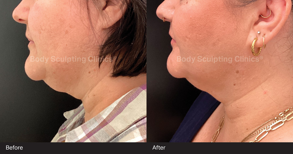 Before and after HIFU skin tightening results at Body Sculpting Clinics Sydney