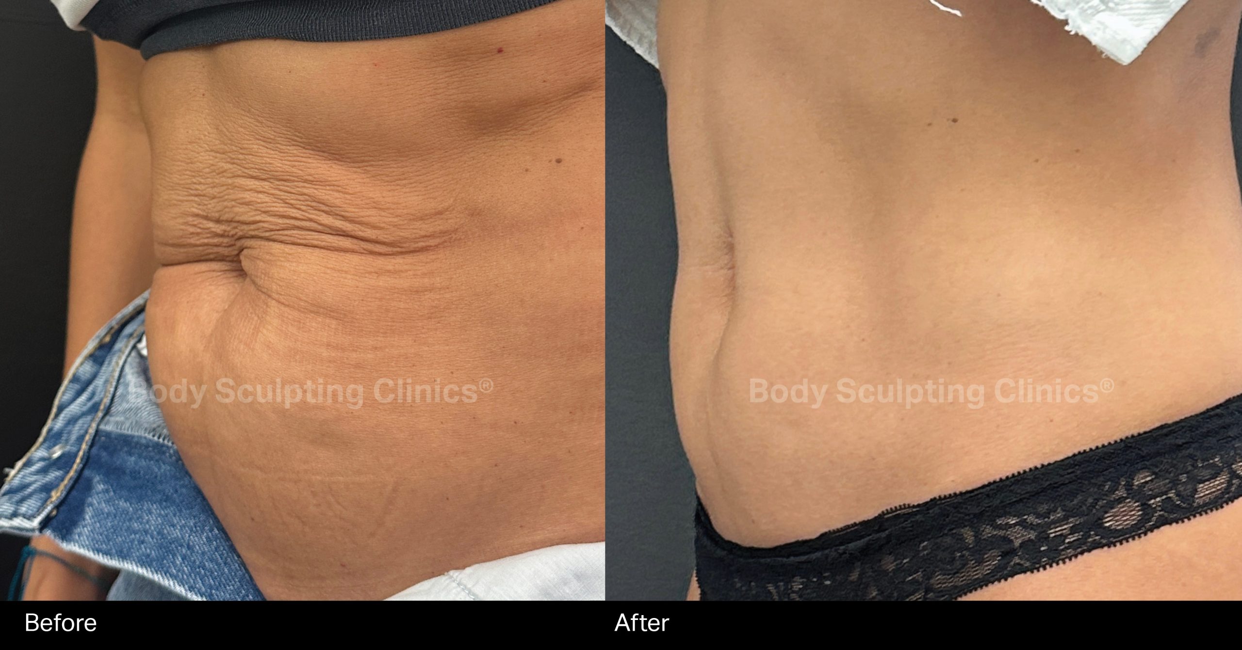 LIPOsculpt-HIFU-body-sculpting-clinics-before-after-treatment-002