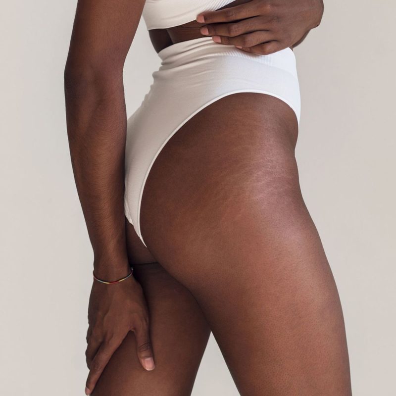 Image of skin texture showing the appearance of stretch marks before treatment