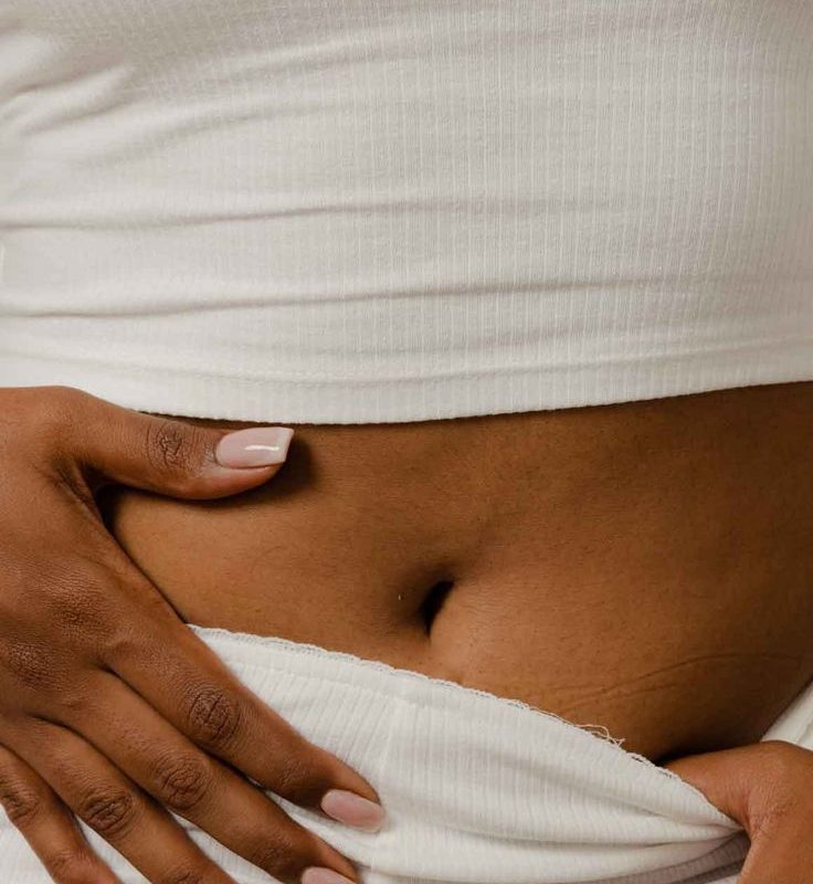 Abdomen showing loose or lax skin before non-surgical treatment.