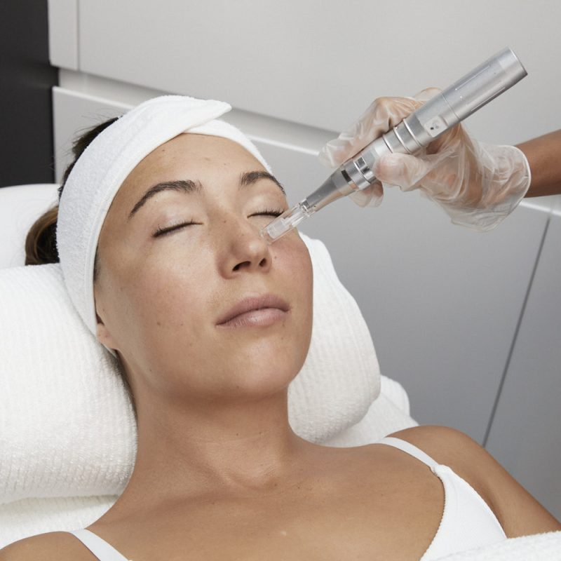Microneedling Sydney