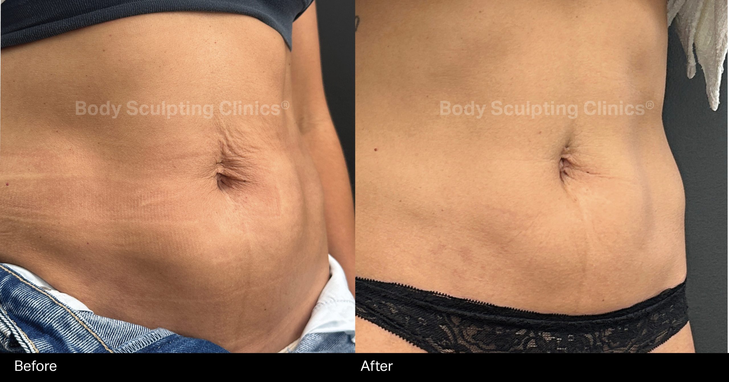 body-hifu-abs-before-after