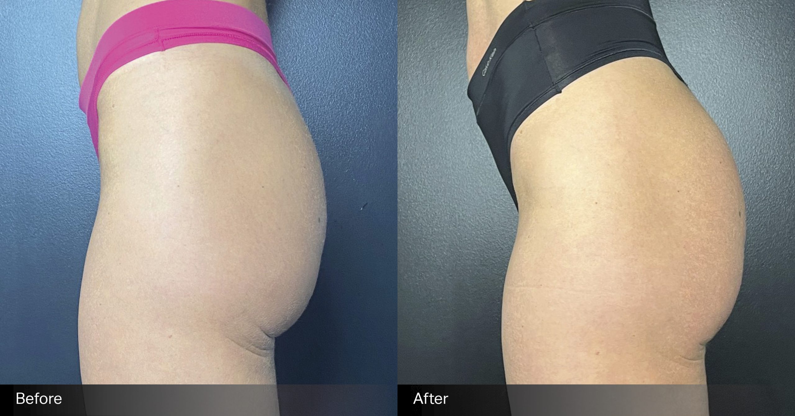 embody-glute-B+A-2