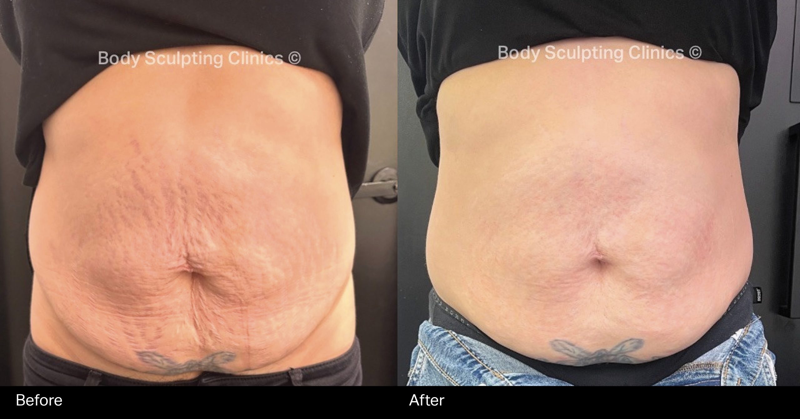 hifu-body-abs-before-after