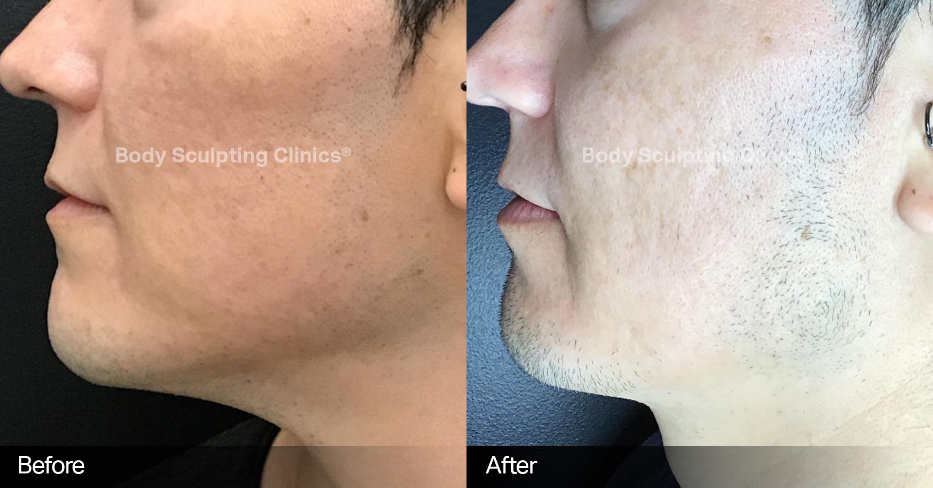 Microneedling Before and After 3