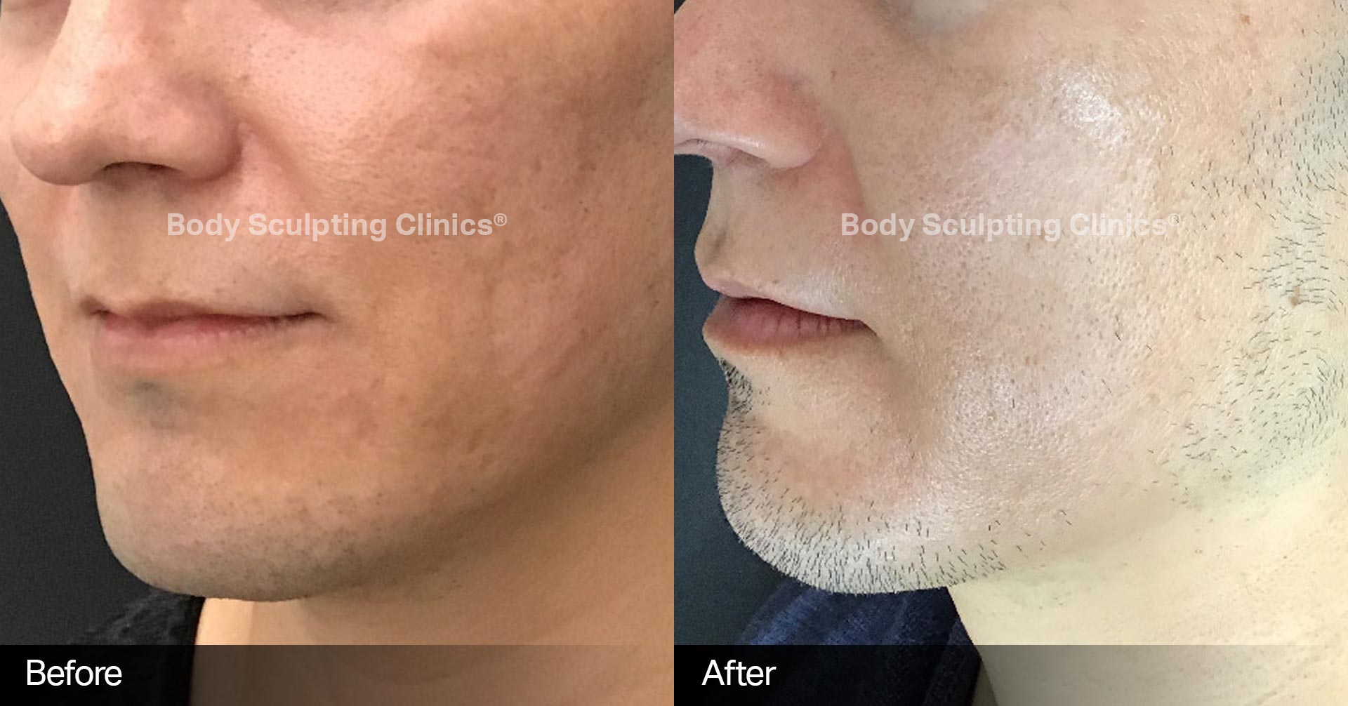 Microneedling Before and After 4