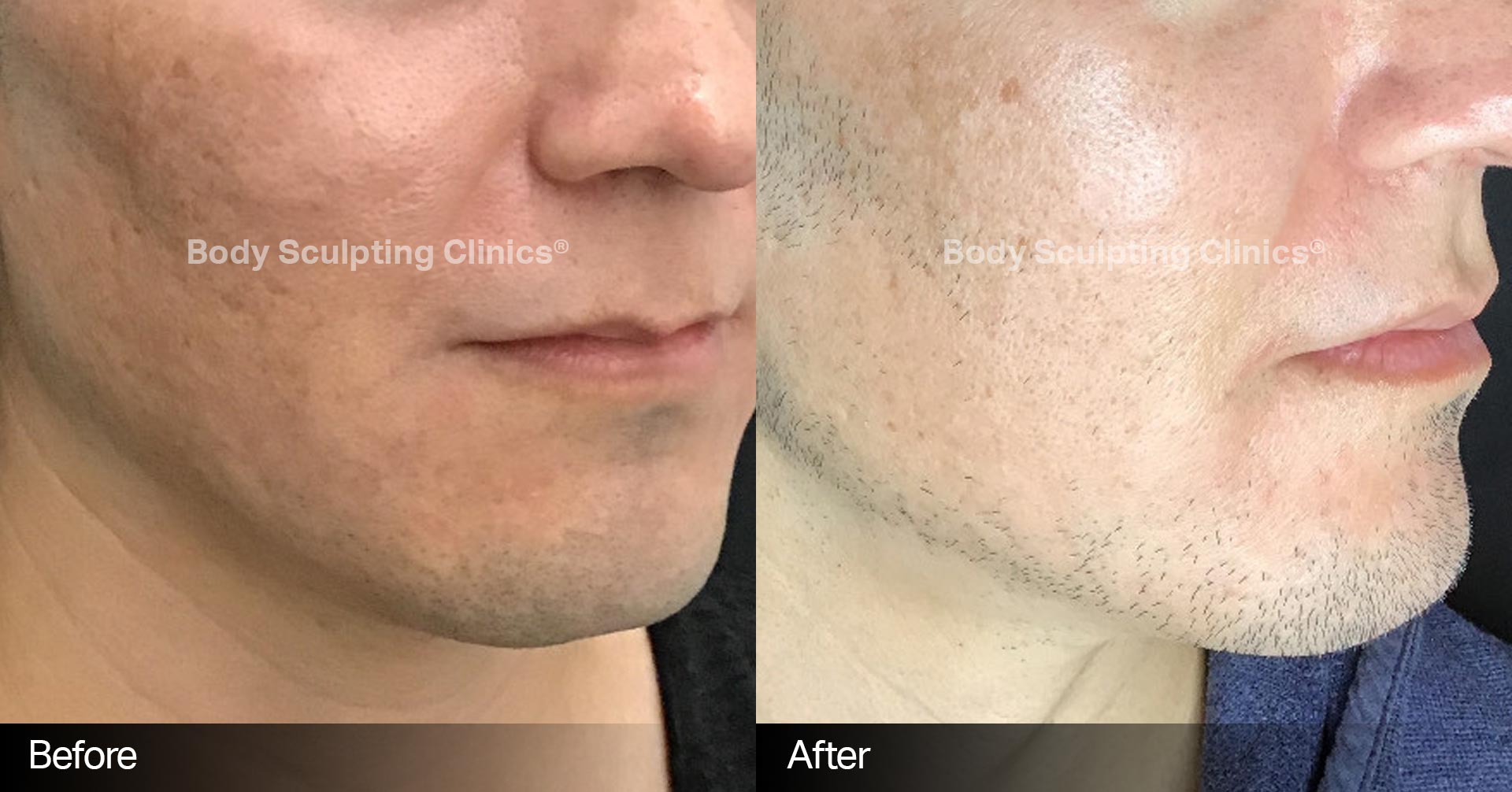 Microneedling Before and After 2