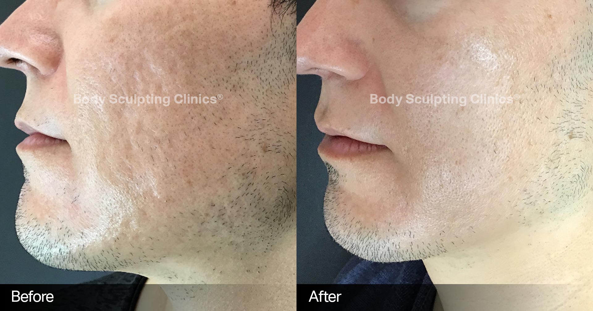 Microneedling Before and After 1