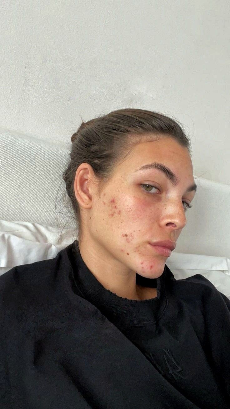 An aesthetic close-up of a person with acne-prone skin, representing the skin concerns treated at Body Sculpting Clinics Sydney.