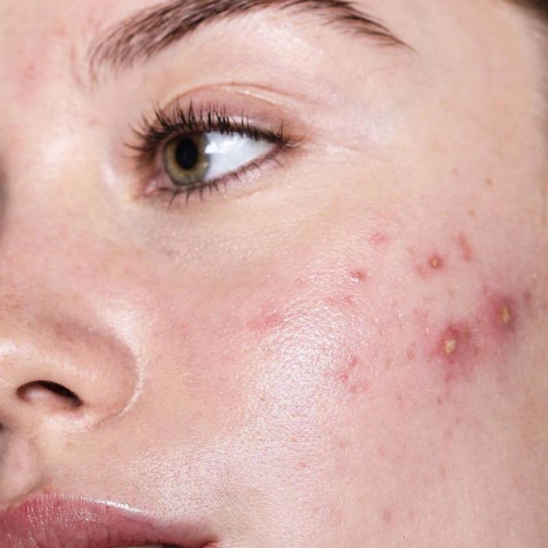 An aesthetic close-up of a person with acne-prone skin, representing the skin concerns treated at Body Sculpting Clinics Sydney.
