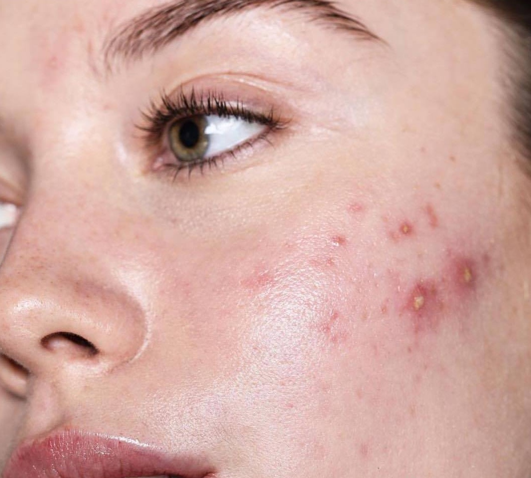 An aesthetic close-up of a person with acne-prone skin, representing the skin concerns treated at Body Sculpting Clinics Sydney.