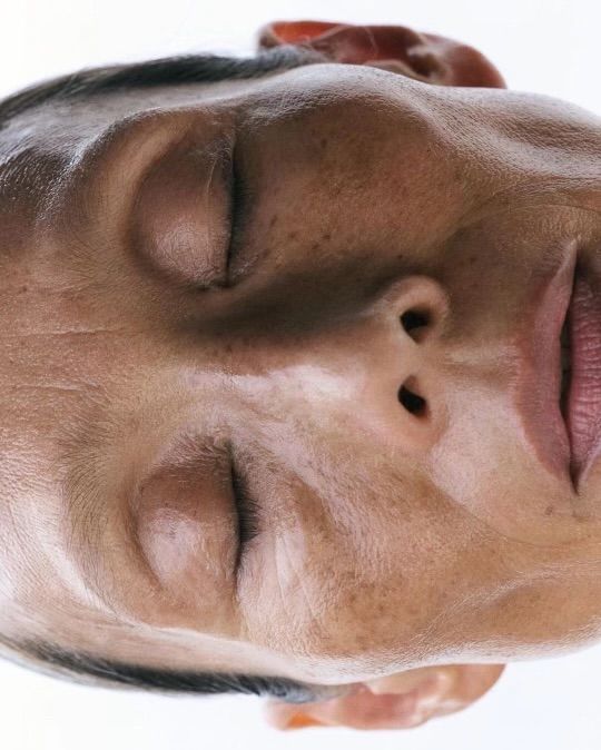 Close-up of a patient's face with visible hyperpigmentation and sun damage, suitable for cosmetic-grade chemical peel treatments at Body Sculpting Clinics.