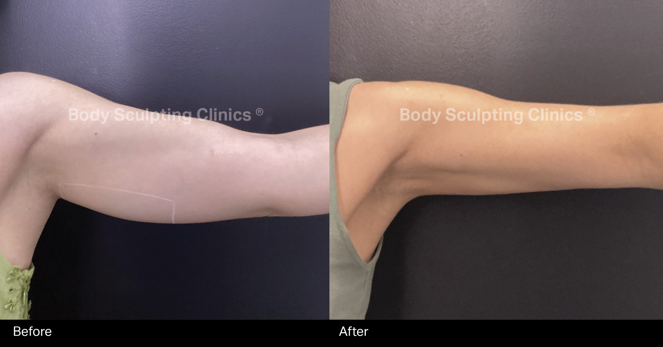 Side-by-side before and after results of a LipoSculpt HIFU body contouring treatment on a client's upper arm, showing visible skin tightening and fat reduction.