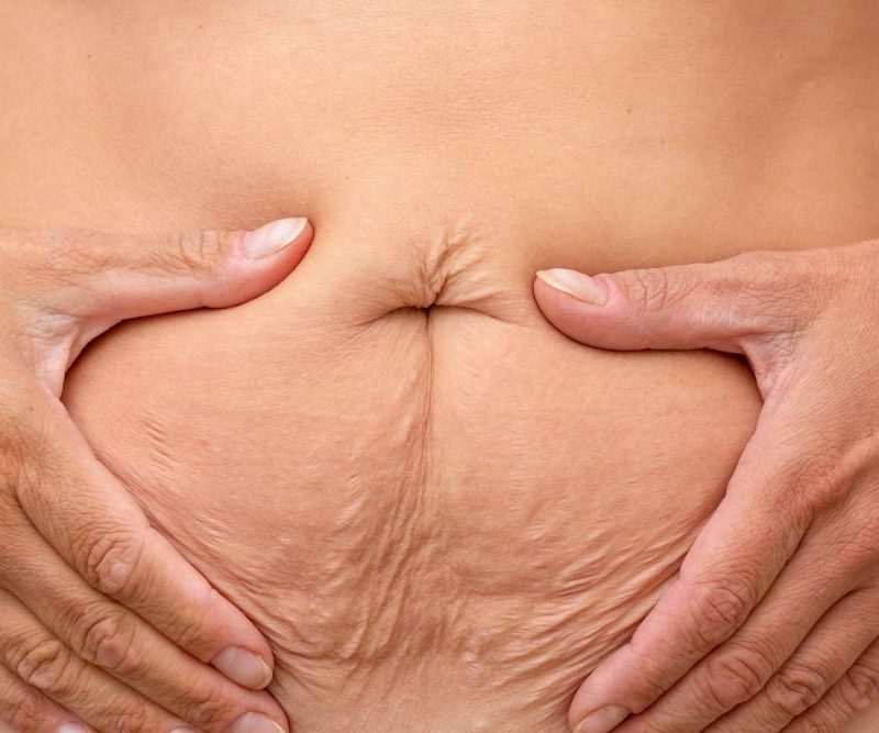 Hands framing loose abdominal skin and skin laxity on the stomach following medical weight loss.