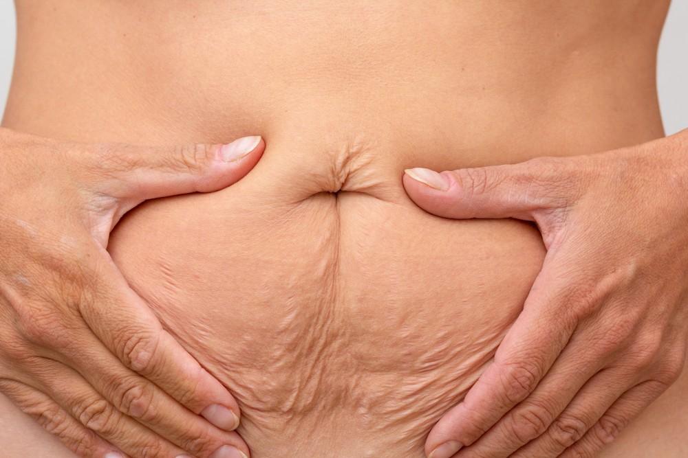 Hands framing loose abdominal skin and skin laxity on the stomach following medical weight loss.
