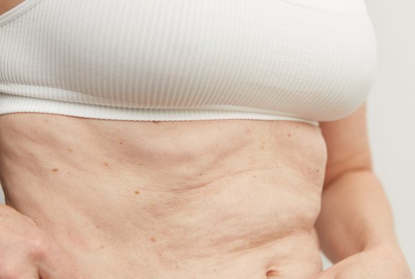 Close-up of a woman wearing a white ribbed crop top, gently touching the skin on her stomach to show loose skin texture before a HIFU body treatment.