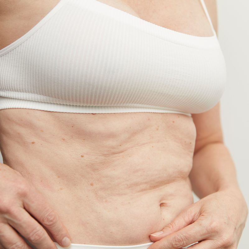 Close-up of a woman wearing a white ribbed crop top, gently touching the skin on her stomach to show loose skin texture before a HIFU body treatment.